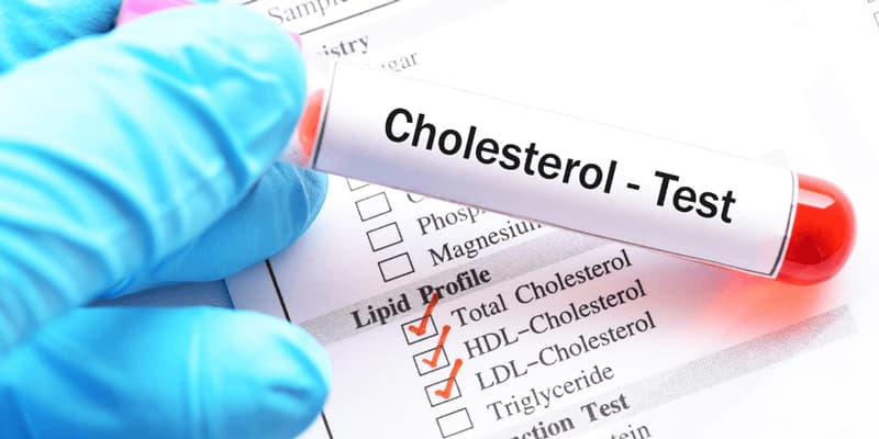 کلسترول خون - تفسیر میزان کلسترول در آزمایش خون